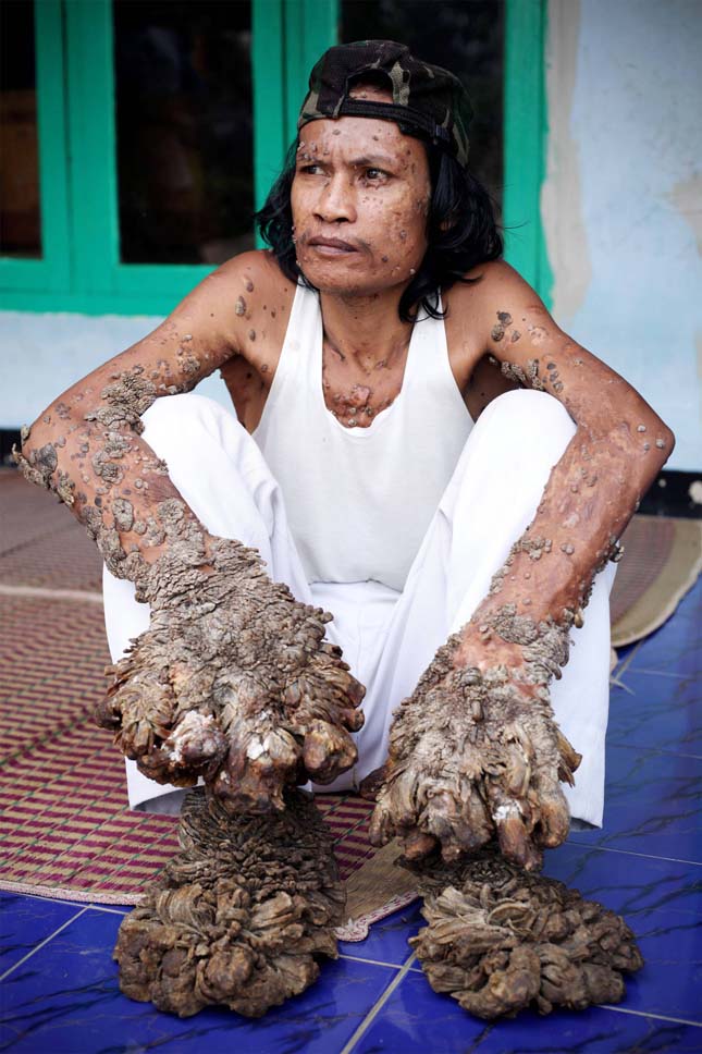 Ritka betegségben szenved az indonéziai faember