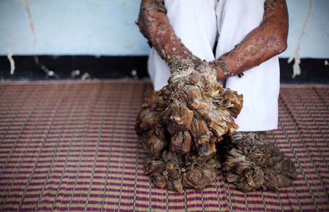 Indonesian "Tree Man" Continues Treatment For Human Papilloma Virus