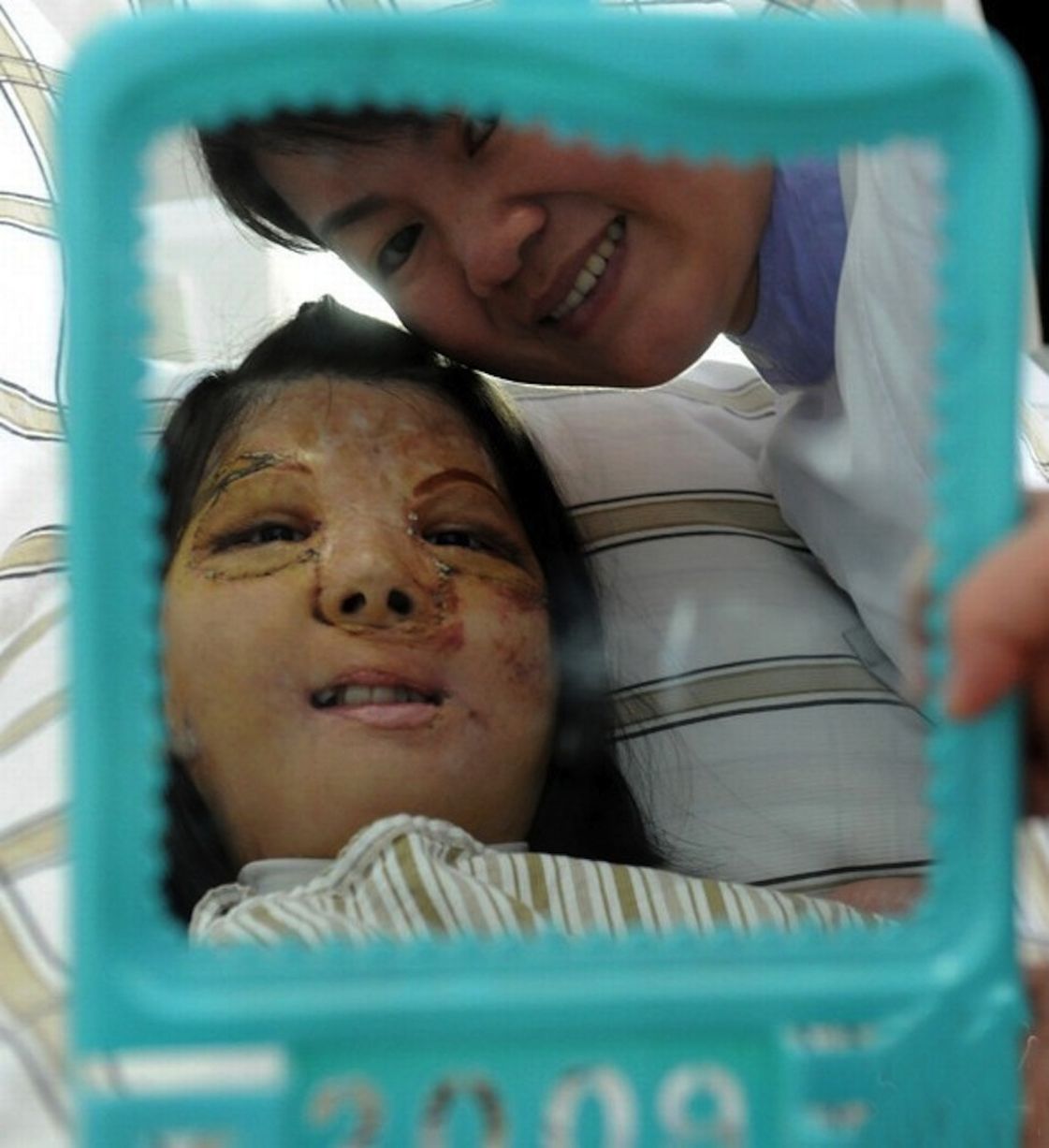 Az első mosoly 12 év után: új arcot kapott egy tinédzser lány Kínában - fotó és videó