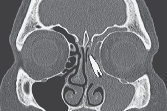 Elrontott fogimplantátum: a csavar az orrnyeregig csúszott fel - sokkoló röntgenkép és fotó