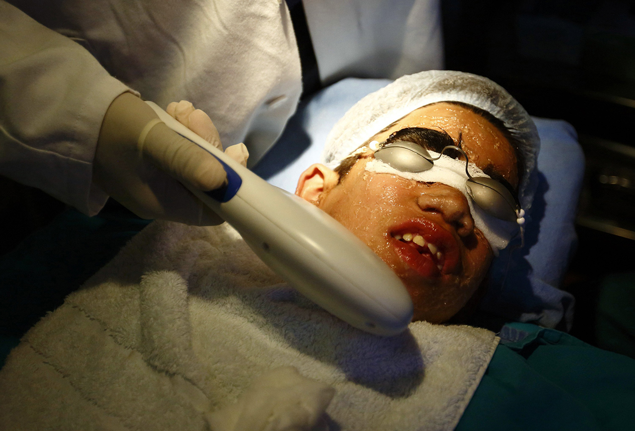 Niraj Budhathoki reacts to pain while undergoing laser hair removal treatment at Dhulikhel Hospital in Kavre