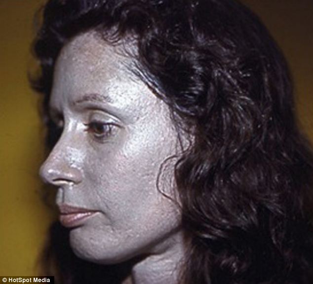 Az ezüst arcú hölgy - egész életét tönkretette egy orrcsepp