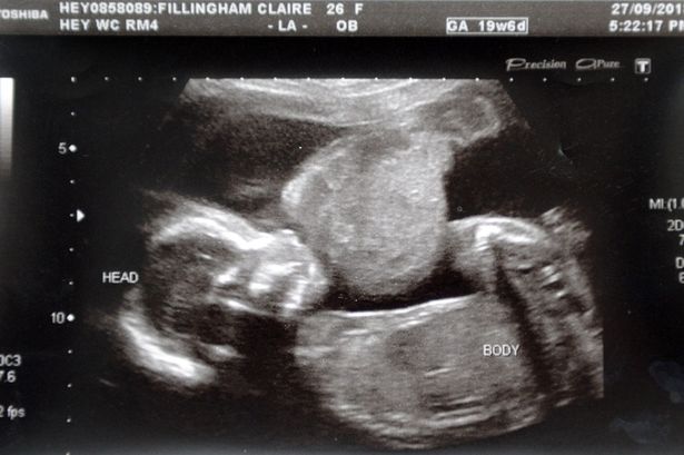 Claire-Fillingham-baby-scan-3101588