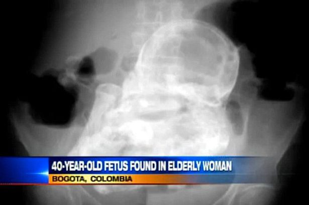 44 év után derült ki, hogy elhalt magzat miatt fáj a nő hasa