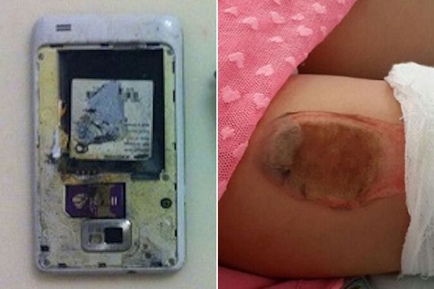 Súlyos sérülést okozott a kislány zsebében felrobbanó telefon – fotók