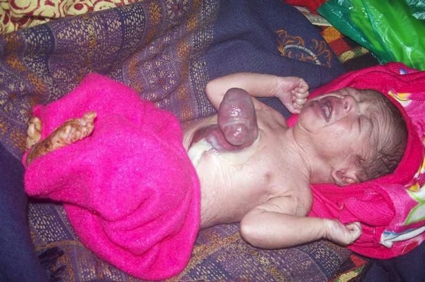 Testen kívüli szívvel született a baba – megrázó képek