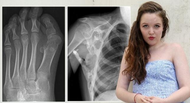 Második csontváz nő a 18 éves lány testében