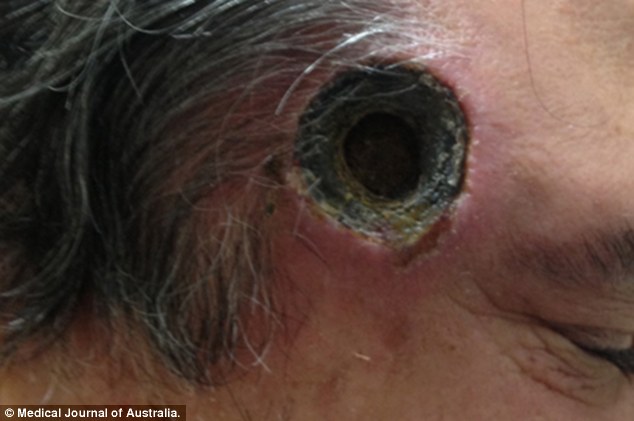 Az ausztrál férfi kenőccsel próbálta kezelni bőrrákját - sokkoló fotó