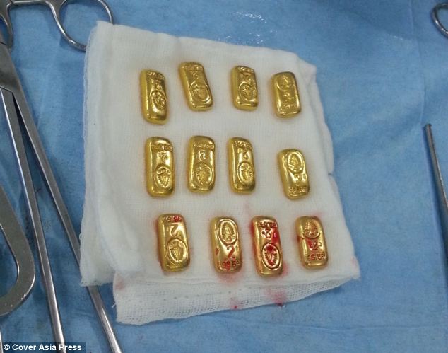 12 aranyrudat találtak az indiai üzletember gyomrában - sokkoló képek