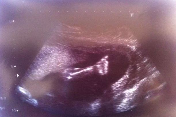 Ultrahangképen jelezte a beteg baba, hogy élni akar - fotó