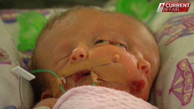 19 napig élt az ausztrál kétarcú kislány