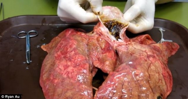 Sokkoló kísérlet: így néz ki egy tüdő 60 cigi elszívása után – videó
