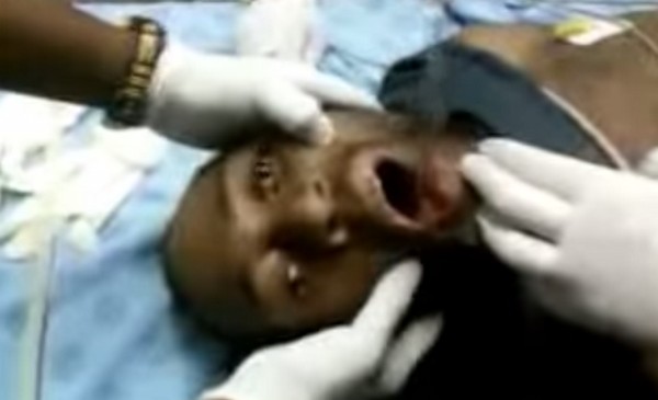 Rendkívüli pillanat! Orvosok egy mobiltelefont távolítanak el egy férfi szájából- videó
