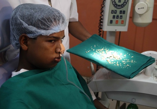 232 fogát húzták ki egy indiai fiúnak! – fotók