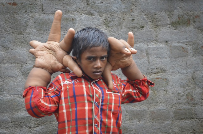 Egy indiai kisfiú 8 kilós kezekkel él