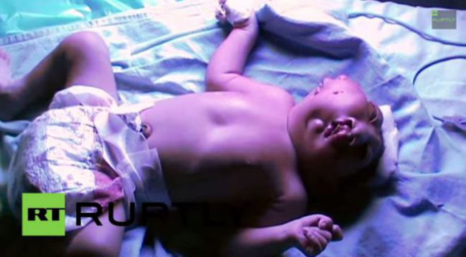 Két arccal született egy indiai csecsemő – sokkoló videó