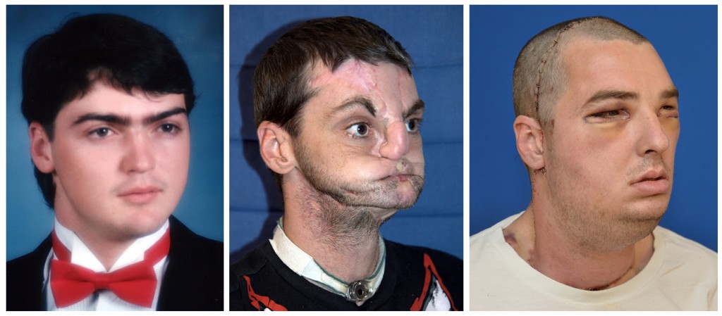 MOST EXTENSIVE FULL FACE TRANSPLANT