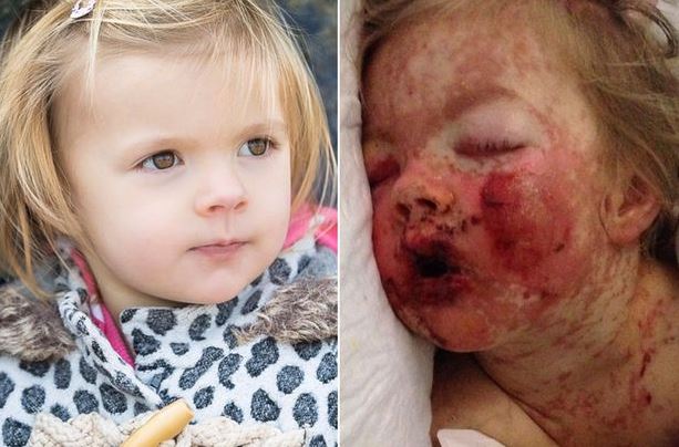 Élet-halál között volt 10 napig a fájdalomcsillapító miatt a kislány – sokkoló fotó