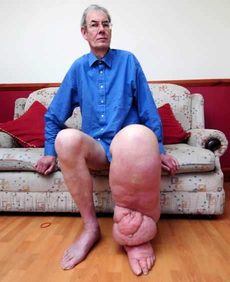 Michael Cull, aged 66 from Rosehearty, Fraserburgh in Aberdeenshire.  A pensioner who has been branded a modern day 'Elephant Man' has been given fresh hope for treatment of his mystery disease.  Michael Cull has endured a decade of pain after his left leg ballooned to more than two stone in weight, leaving him incapable of walking and making him the target of cruel taunts from strangers.  See Northscot Story ELEPHANT MAN. The retired computer technician from Rosehearty accused the medical profession of turning its back on him earlier this year after being told there was nothing that could be done to treat his condition.  But he is now optimistic that he might finally be on the brink of a life-changing operation after being referred to a specialist in the North of England.  He said doctors in Hull were discussing surgery to remove the deformed tissue from his lower leg and return it to a more manageable size.  He said: "I am absolutely elated that all these years of pain may be coming to an end." 8 September 2014