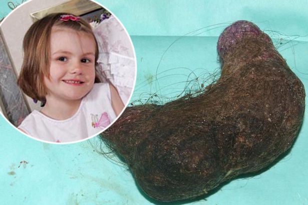 Az ötéves kislányból a gyomrát kitöltő hajcsomót operáltak ki - döbbenetes fotók!