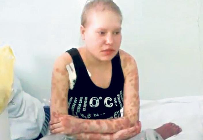 Krokodil drog miatt kellett amputálni egy magyar lány karját 