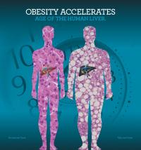 Az elhízás gyorsítja a májszövet biológiai öregedését