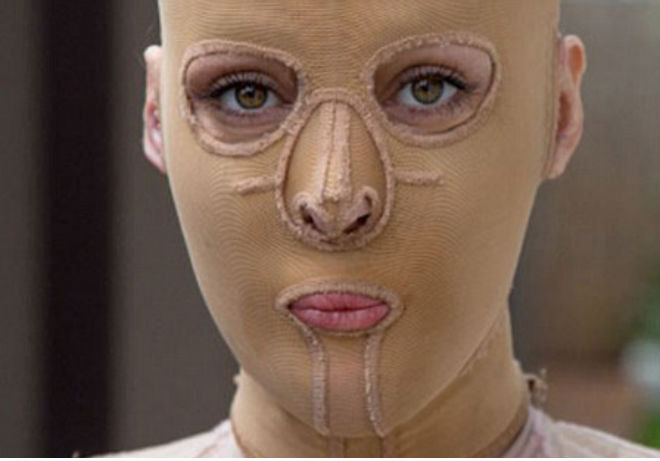 Ilyen lett a nő arca, aki 2 évig maszkban élt, miután felgyújtották– megrázó fotók, videó