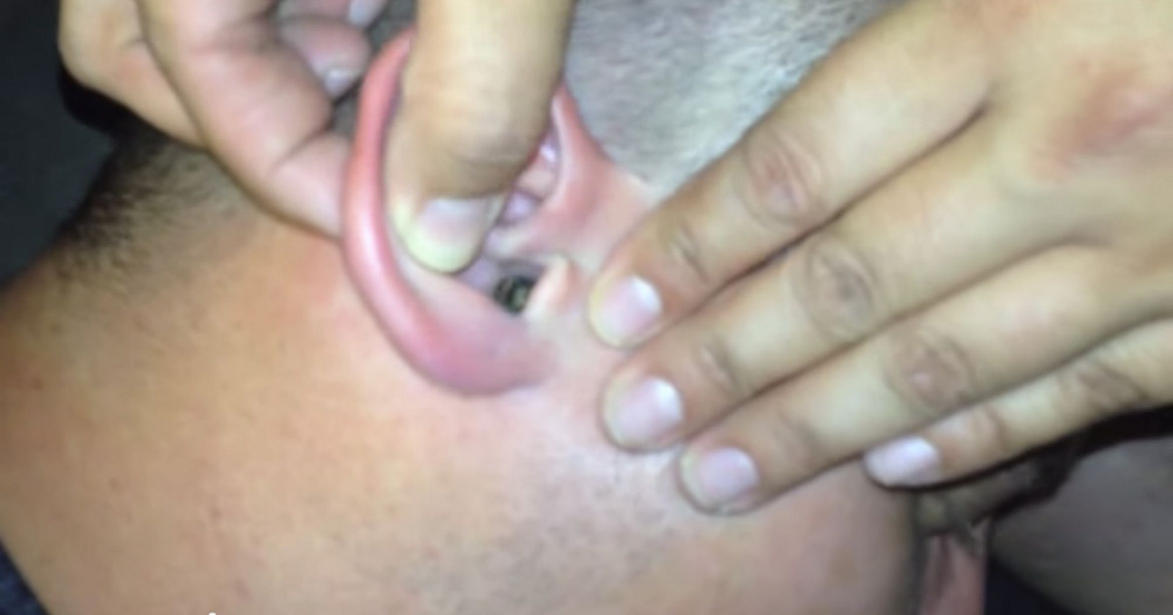 Élő molylepkét szedtek ki a füléből – +18 fotók és videó