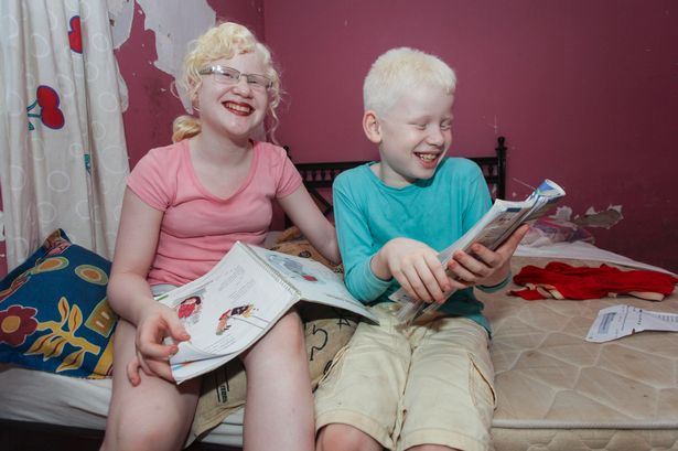 Albino-kids (3)