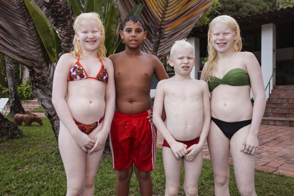 Albino-kids (4)