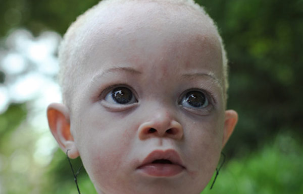Fekete mágia áldozata lehetett egy albínó kislány