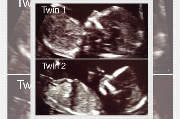 A-scan-showing-the-twins-of-Hayley-Haynes