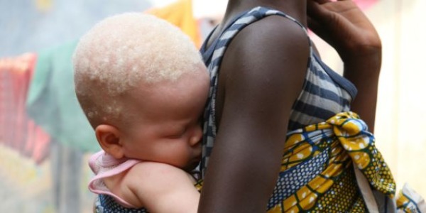 Feldarabolták az albínó kisgyereket