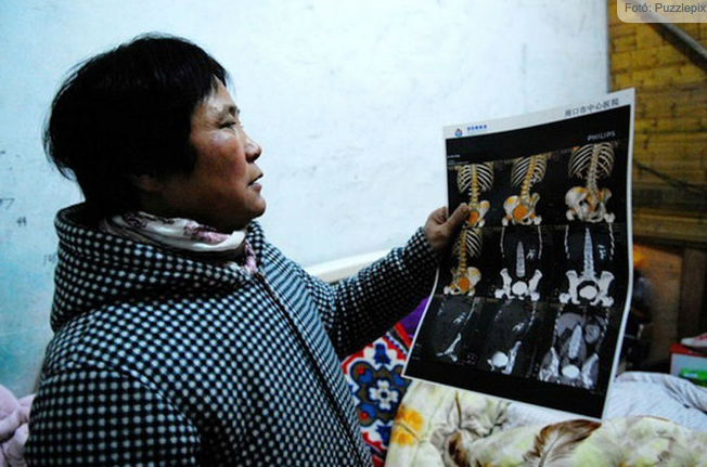 Műtét alatt ellopták a kínai nő veséjét az orvosok