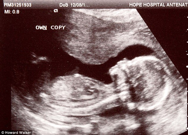 Megrázó! Abortusztablettát adott orvosa a kismamának, a baba mégis életben maradt!