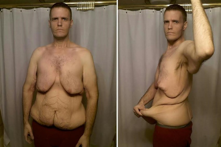 Megmutatta testét a férfi, aki 180 kilót adott le és most plasztikai műtétre gyűjt – videó