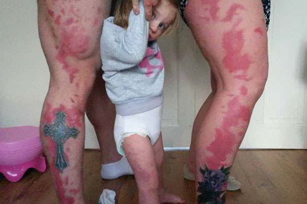 A szülők, akik magukra tetoválták kislányuk anyajegyeit, hogy ne érezze magát rosszul.