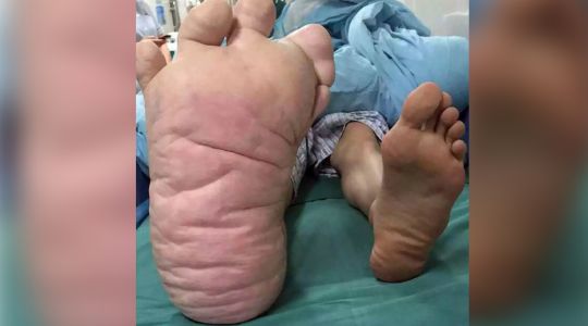 Gigaméretűre nőtt a kínai fiú lábfeje – sokkoló fotók