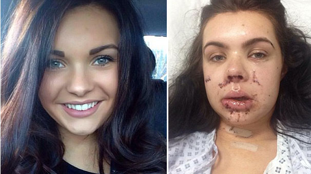 Többé nem tud mosolyogni a lány, akinek üveget robbantottak az arcába – sokkoló fotók 18+