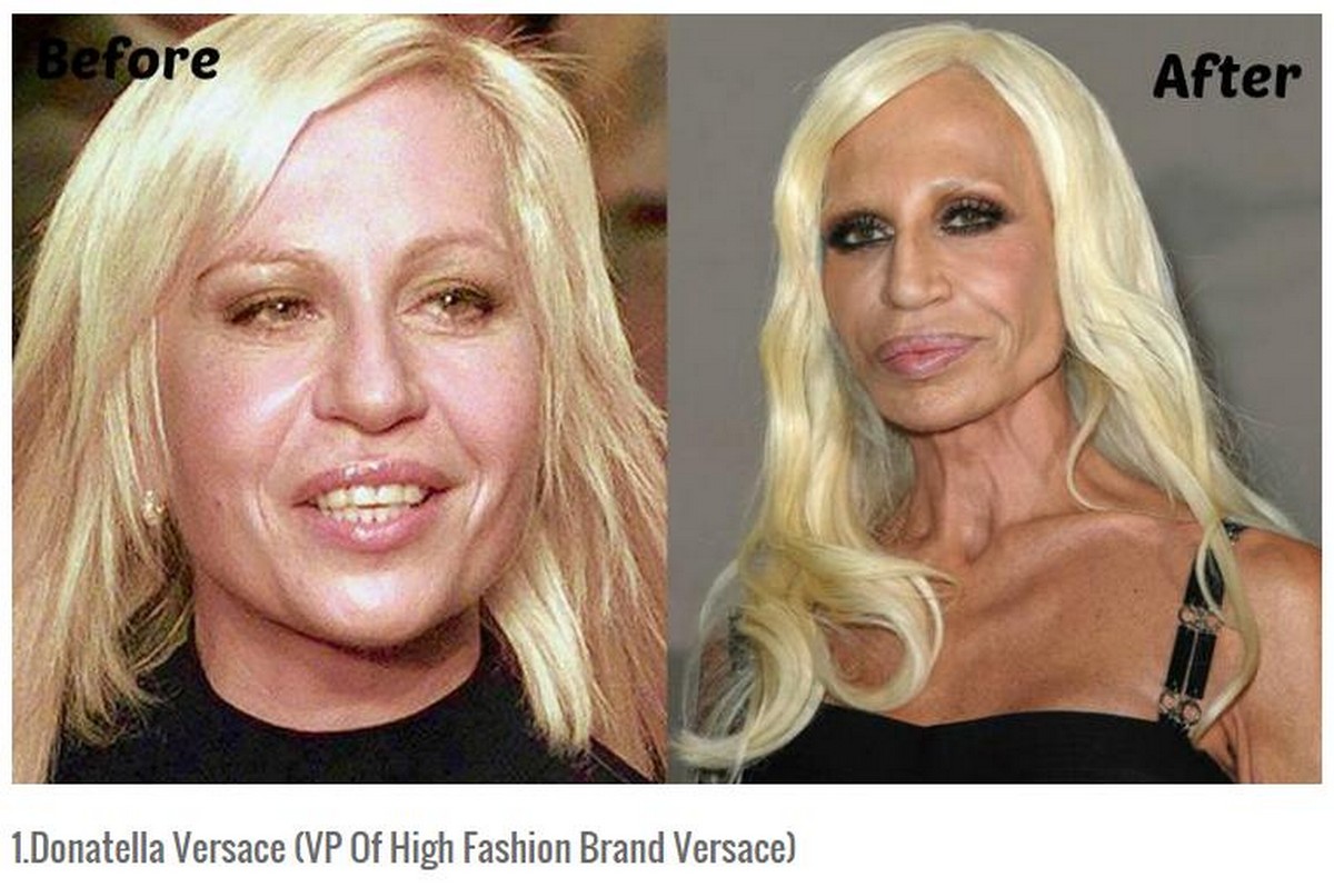 Жертвы пластической хирургии фото до и после знаменитости в россии