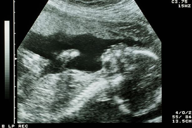 Szívfacsaró – így vettek búcsút a 27. hétre halva született babájuktól a szülők