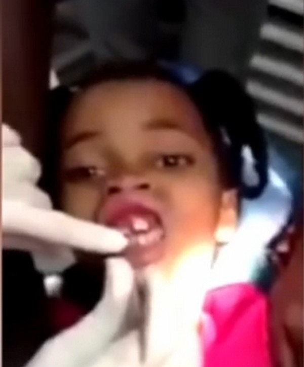 Durva felvétel! 15 kukacot szedett ki a fogorvos a kislány szájából- 18+