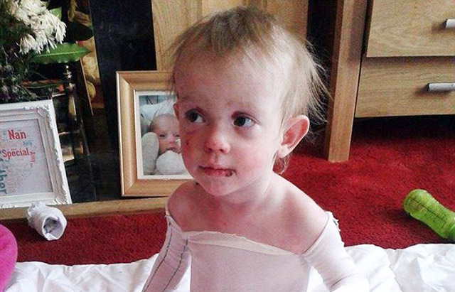 Fájdalmas betegsége miatt senki sem érintheti meg a 2 éves kislányt – fotók 18+