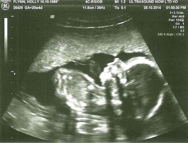 Abortuszt javasoltak az orvosok, de ez a baba meg akart születni – fotók