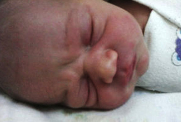 Inkubátorban égett meg a koraszülött baba testének 70 százaléka - sokkoló fotók 18+