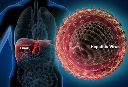 Májbetegek egyesülete: 70 ezer hepatitis C-fertőzött lehet Magyarországon