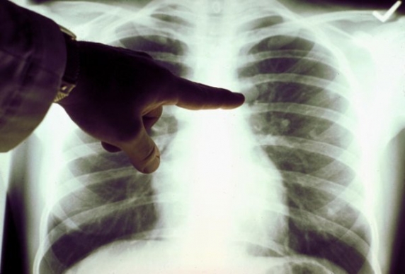 Két tbc-fertőzöttet találtak a Szegedi Tudományegyetemen