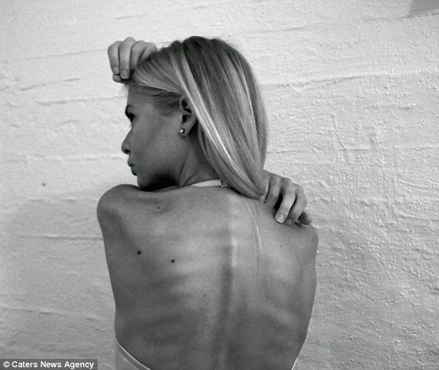 Legyőzte a súlyos anorexiát a 20 éves lány – előtte-utána fotók  a gyógyulásról