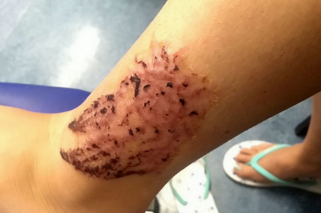 PAY--16-year-old-prom-queen-left-with-chemical-burns-after-getting-holiday-henna-tattoo