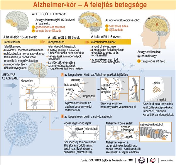 Alzheimer-kór: a felejtés betegsége